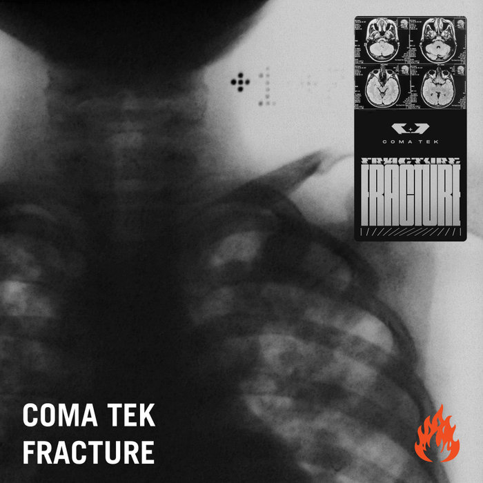 COMA TEK - Fracture